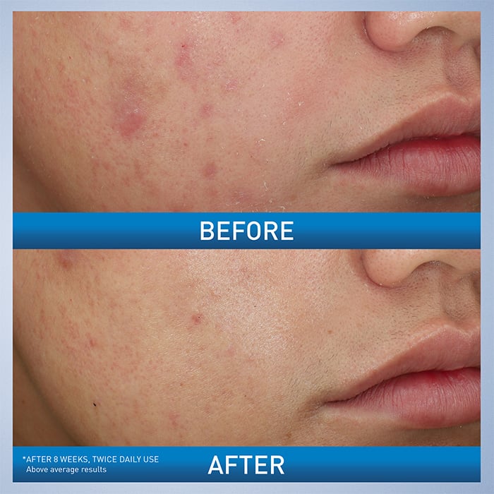 Acne Foaming Cream Wash