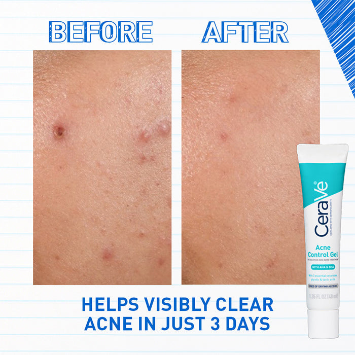 Acne Control Gel